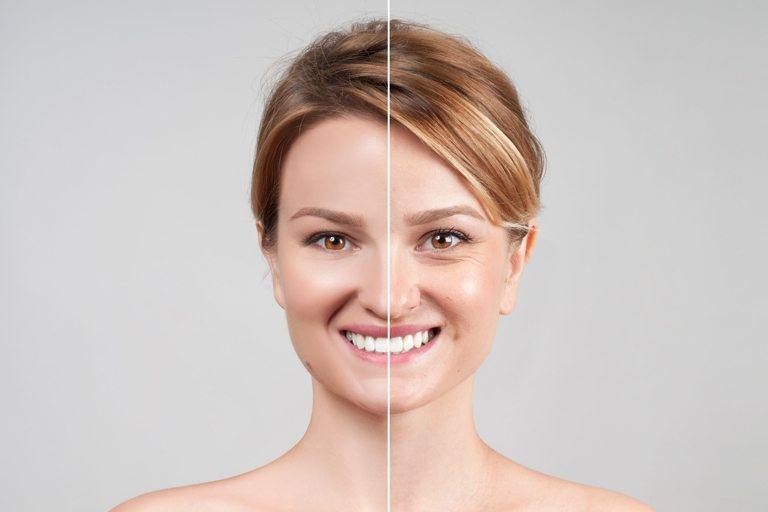 Hoe werkt Botox?